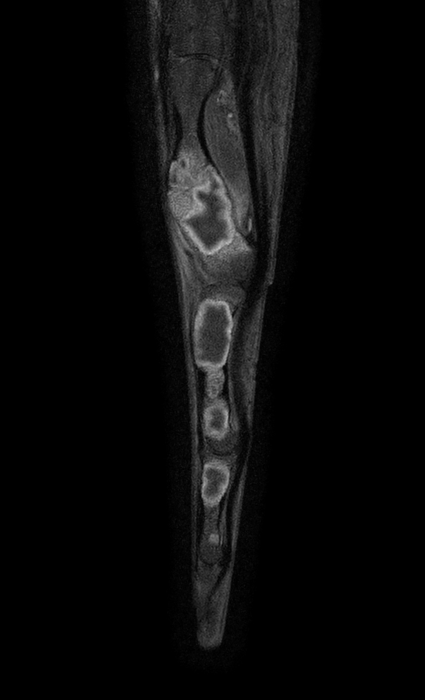 Sagittal T1w mDIXON XD TSE (Partial FatSat) (with gado)