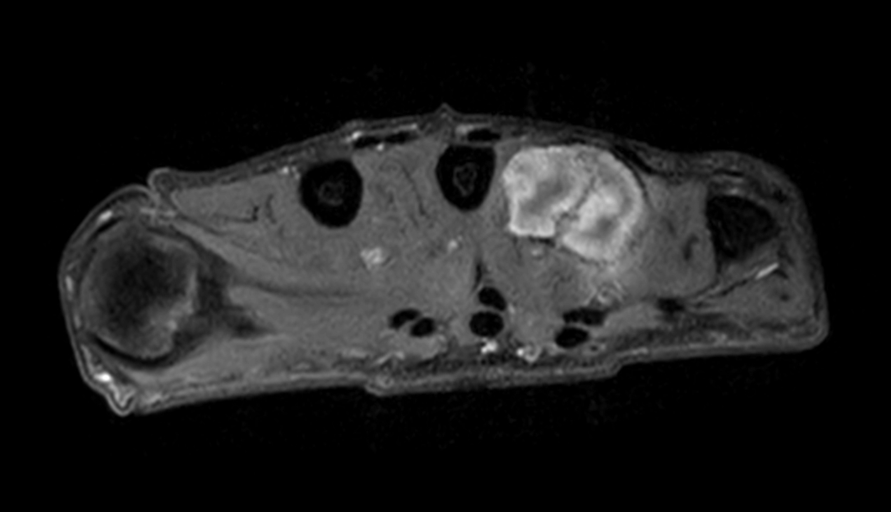 Axial T1w mDIXON XD TSE (Water only) (with gado)