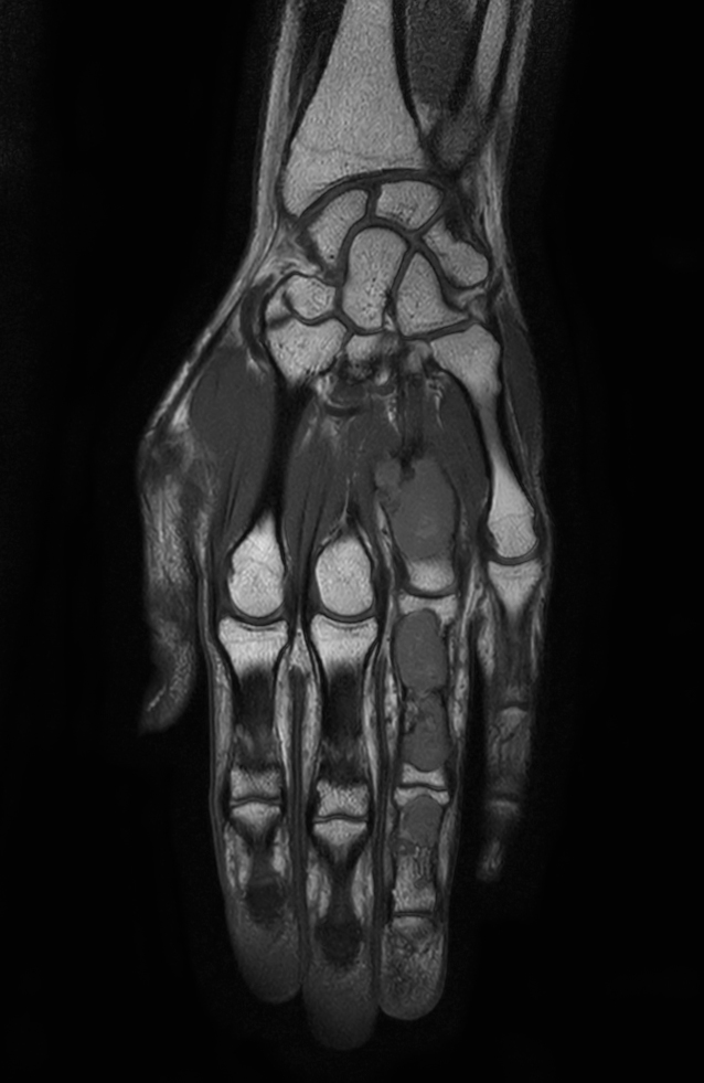 Coronal T1w mDIXON XD TSE (In Phase)