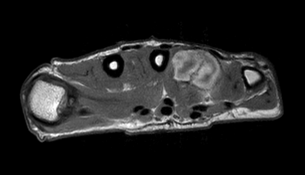 Axial T1w mDIXON XD TSE (In Phase) (with gado)