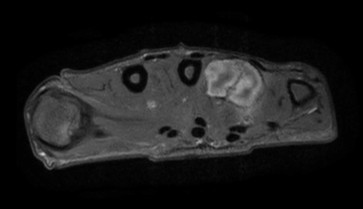 Axial T1w mDIXON XD TSE (Partial FatSat) (with gado)