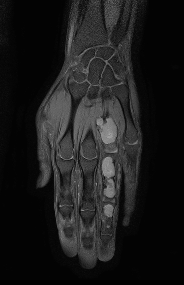 Coronal T1w mDIXON XD TSE (Partial FatSat)