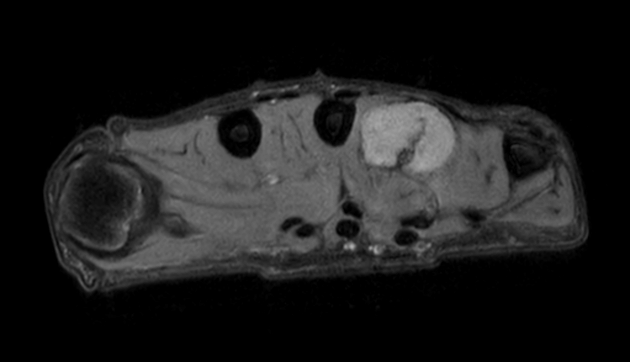 Axial PDw mDIXON XD TSE (Water only)