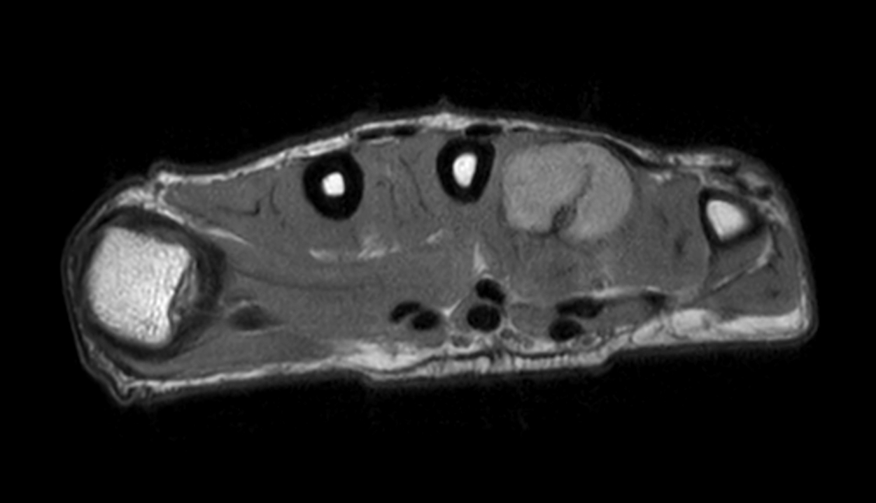 Axial PDw mDIXON XD TSE (In Phase)