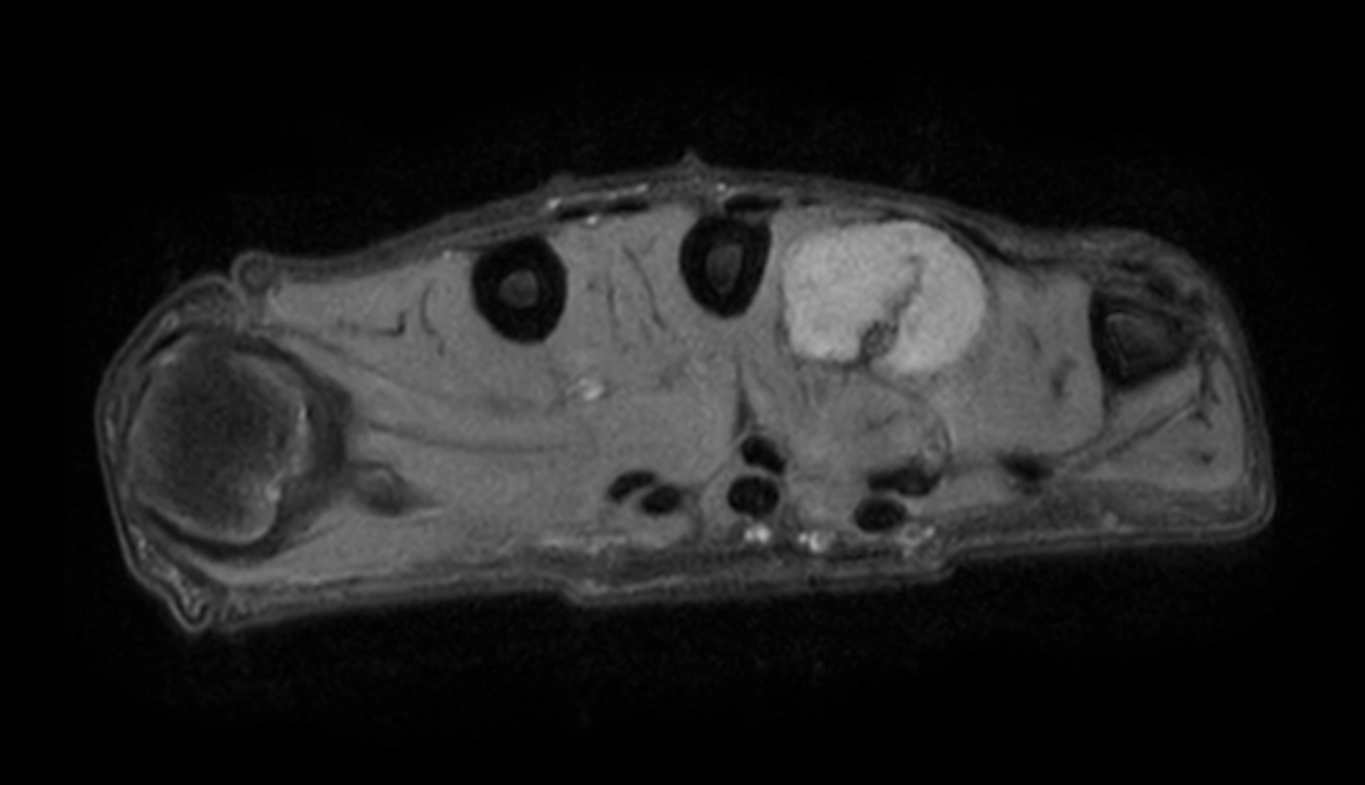 Axial PDw mDIXON XD TSE (Partial FatSat)