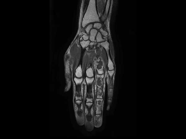 Coronal T1w mDIXON XD TSE (In Phase) (with gado)