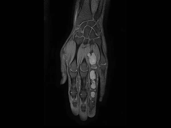 Coronal T1w mDIXON XD TSE (Partial FatSat)