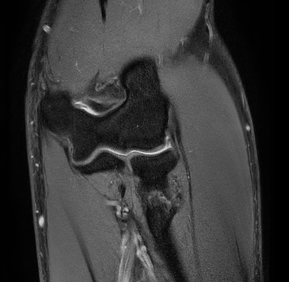 Coronal T1w mDIXON XD TSE (Water only)