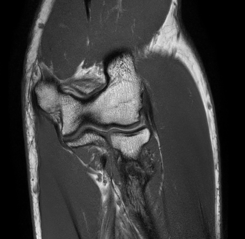 Coronal T1w mDIXON XD TSE (In Phase)