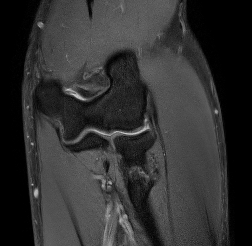 Coronal T1w mDIXON XD TSE (Partial FatSat)