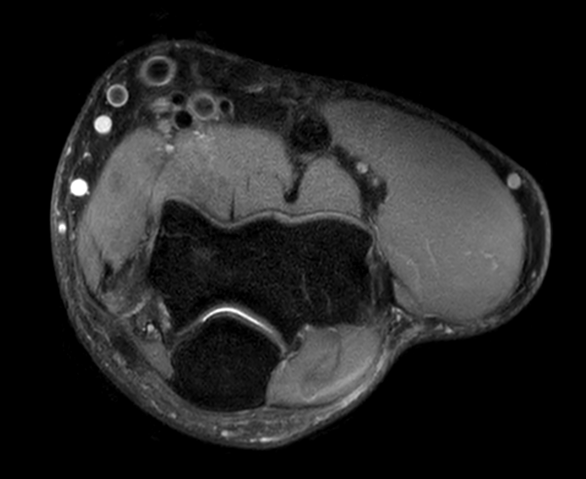 Axial PDw mDIXON XD TSE (Water only)