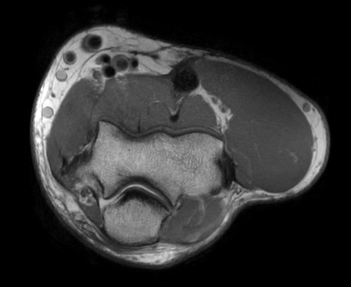 Axial PDw mDIXON XD TSE (In Phase)
