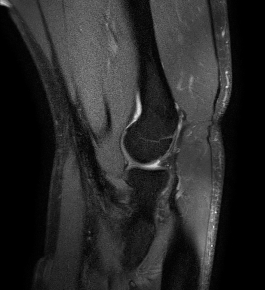 Sagittal PDw SPAIR