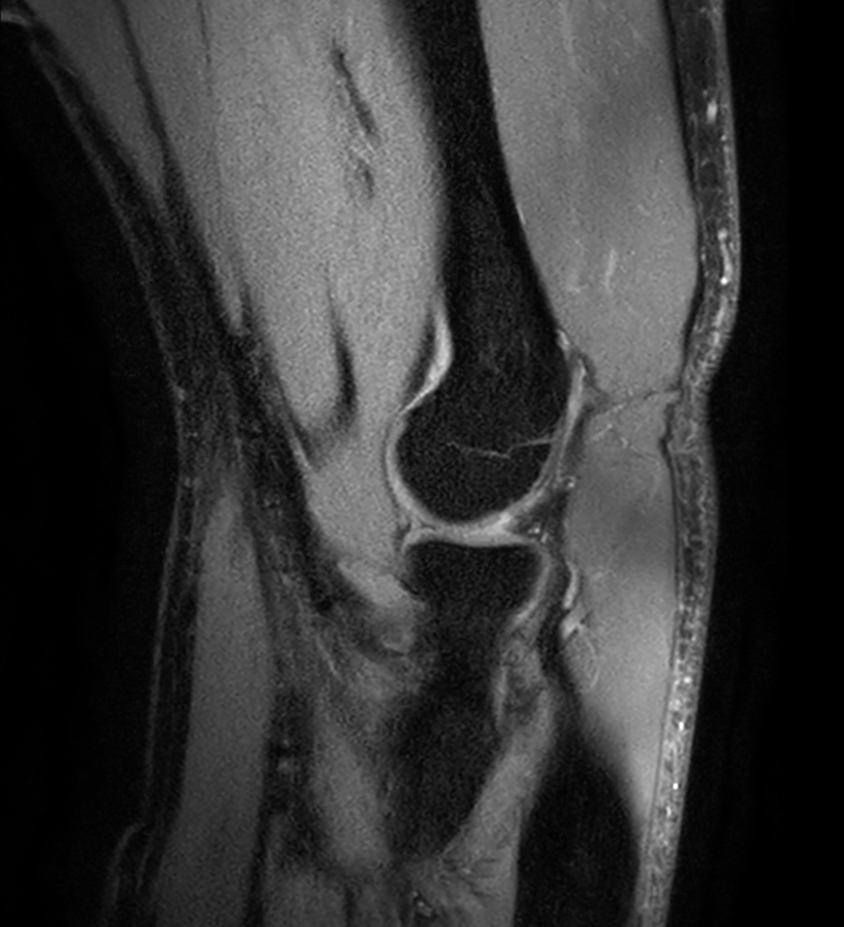 Sagittal PDw mDIXON XD TSE (Water only)