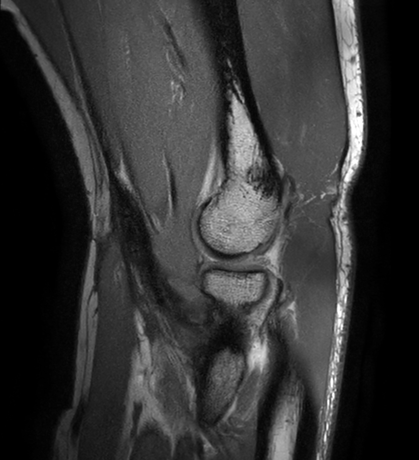Sagittal PDw mDIXON XD TSE (In Phase)