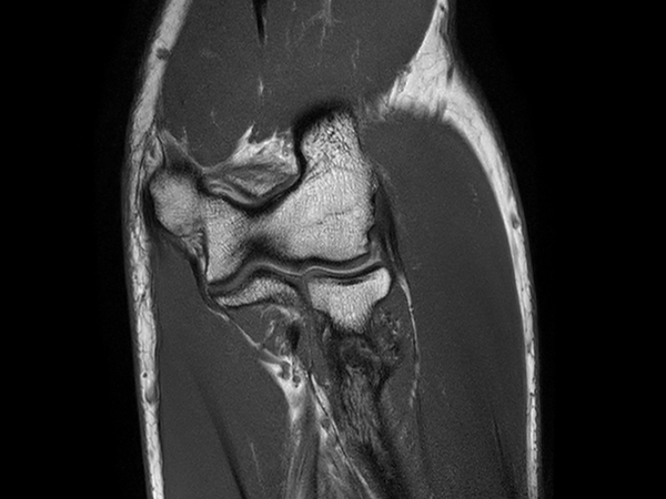 Coronal T1w mDIXON XD TSE (In Phase)