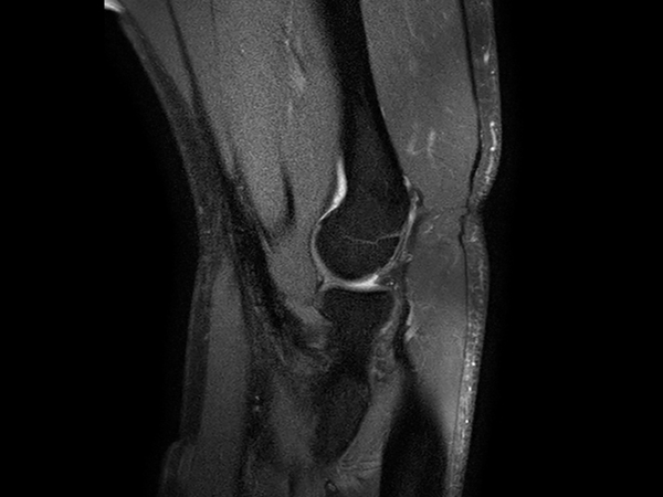 Sagittal PDw SPAIR