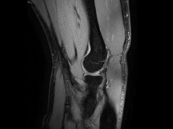 Sagittal PDw mDIXON XD TSE (Water only)