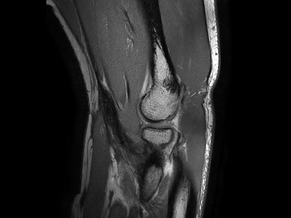 Sagittal PDw mDIXON XD TSE (In Phase)