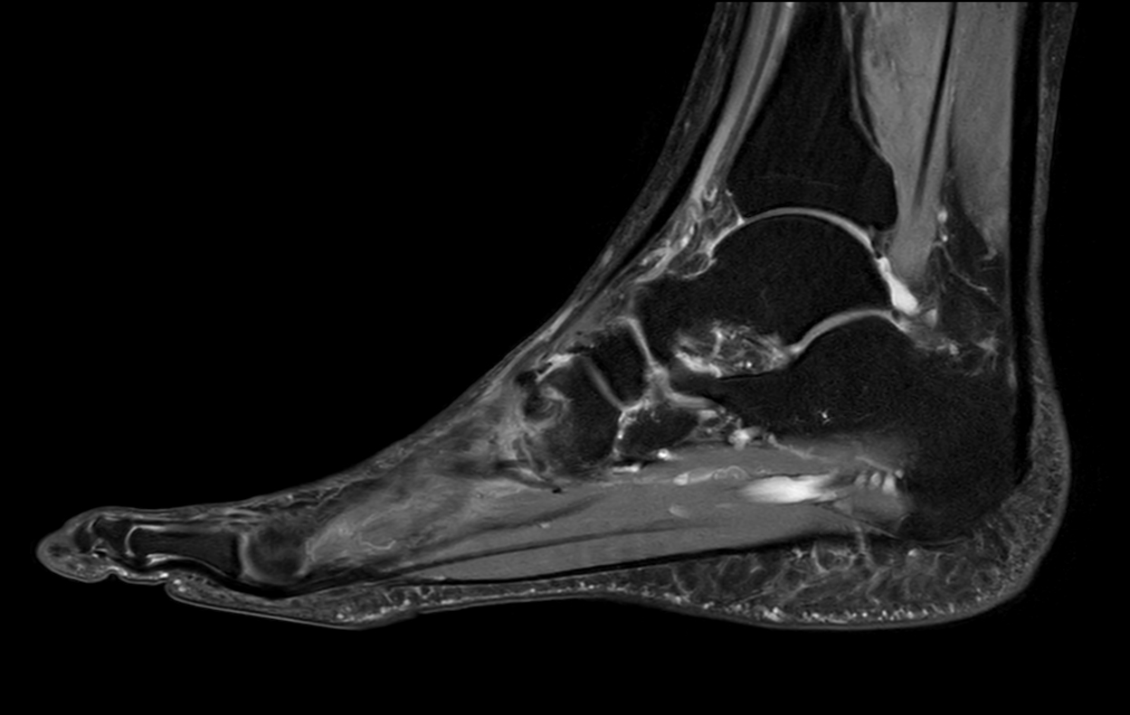 Sagittal PDw mDIXON XD TSE (Water only)