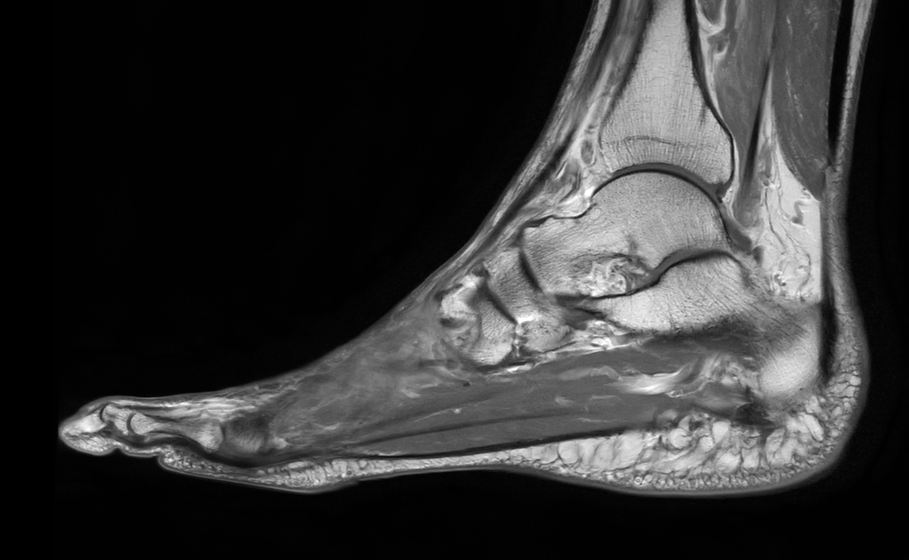 Sagittal T1w TSE with gado