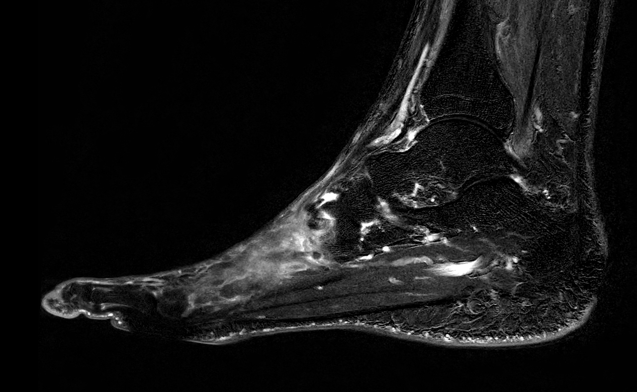 Sagittal T1w TSE with gado (subtraction)