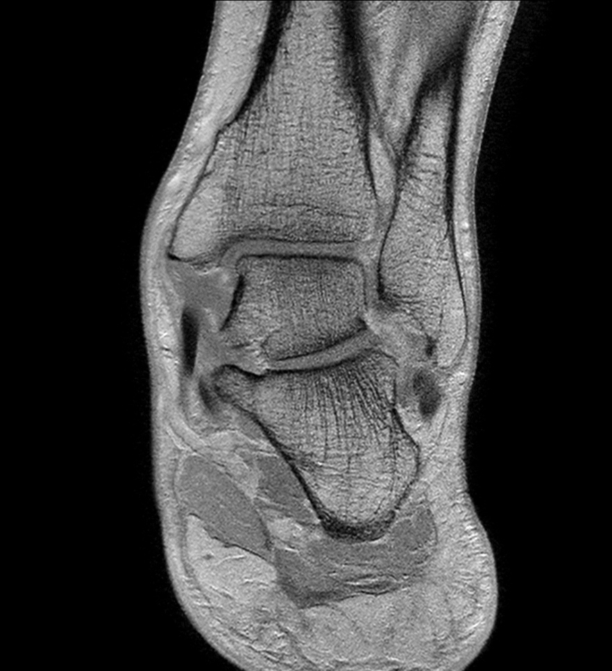 Coronal T1w FFE - 2 mm reformat