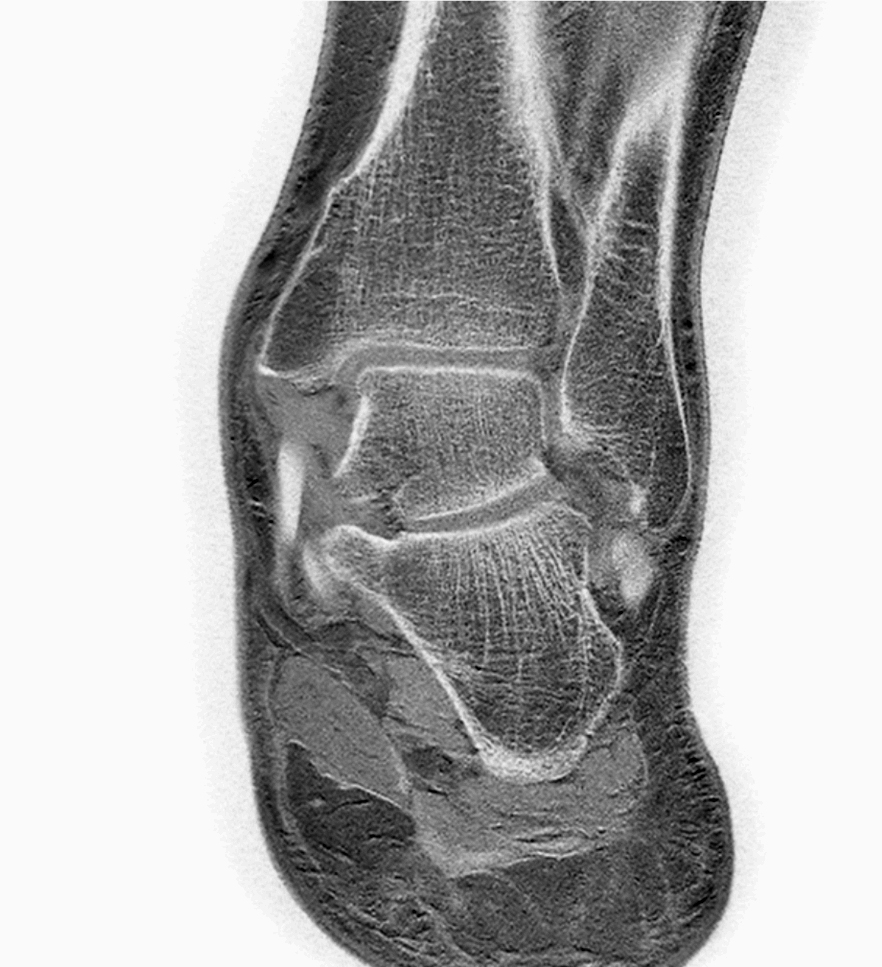 Coronal T1w FFE - 2 mm reformat (inverted window)