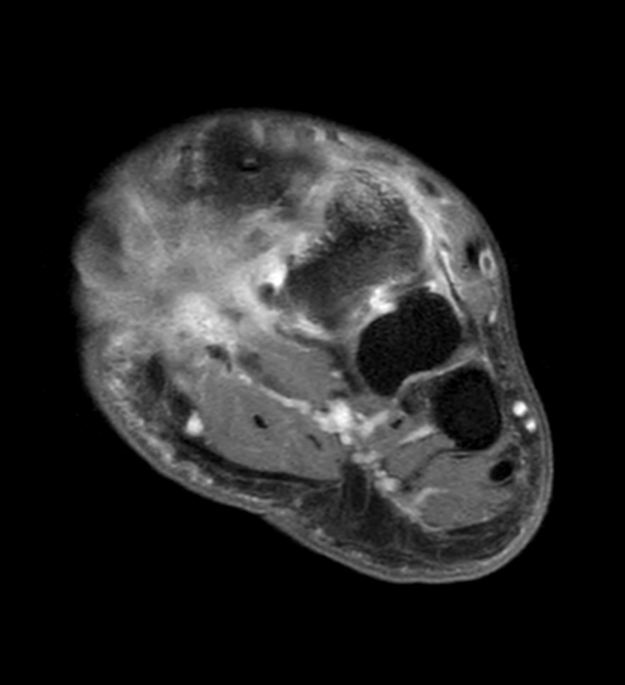 Axial T1w mDIXON XD TSE with gado (Water only)