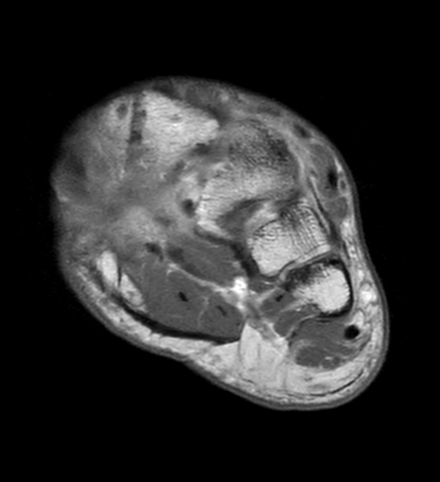 Axial T1w mDIXON XD TSE with gado (In Phase) 