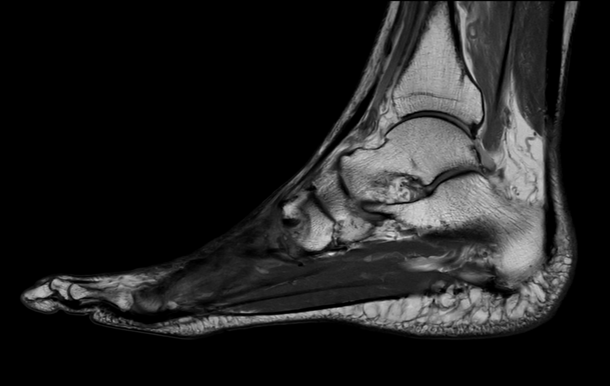 Sagittal PDw mDIXON XD TSE (In Phase)