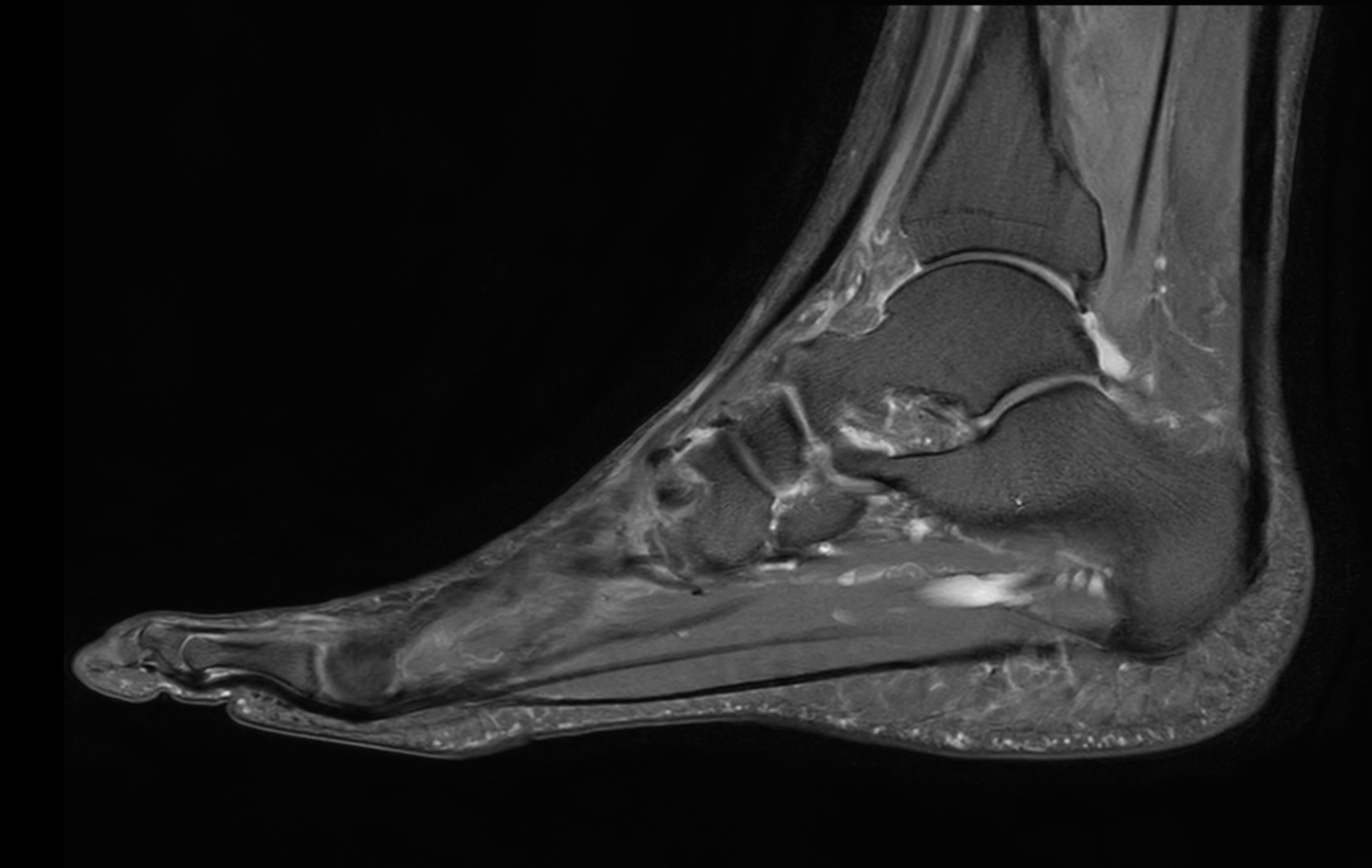 Sagittal PDw mDIXON XD TSE (Partial FatSat)