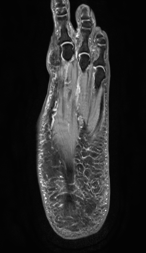 Coronal PDw mDIXON XD TSE (Water only)