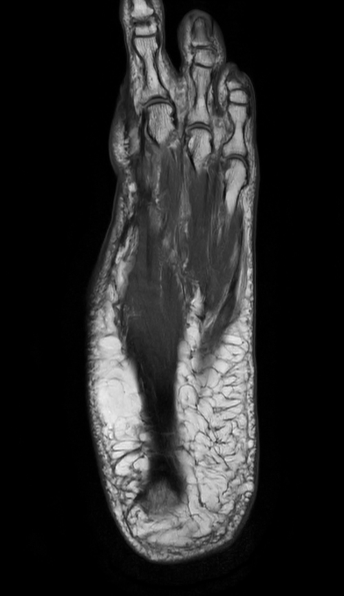 Coronal PDw mDIXON XD TSE (In Phase)
