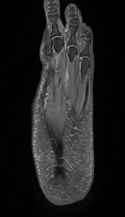 Coronal PDw mDIXON XD TSE (Partial FatSat)