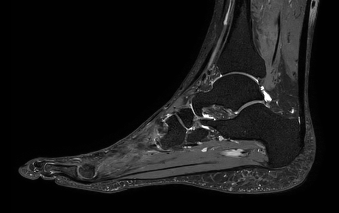 Sagittal 3D VIEW PDw SPAIR