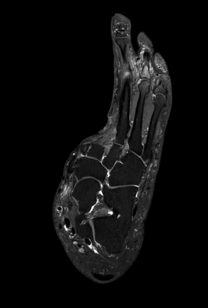 3D VIEW PDw SPAIR - Coronal reformat