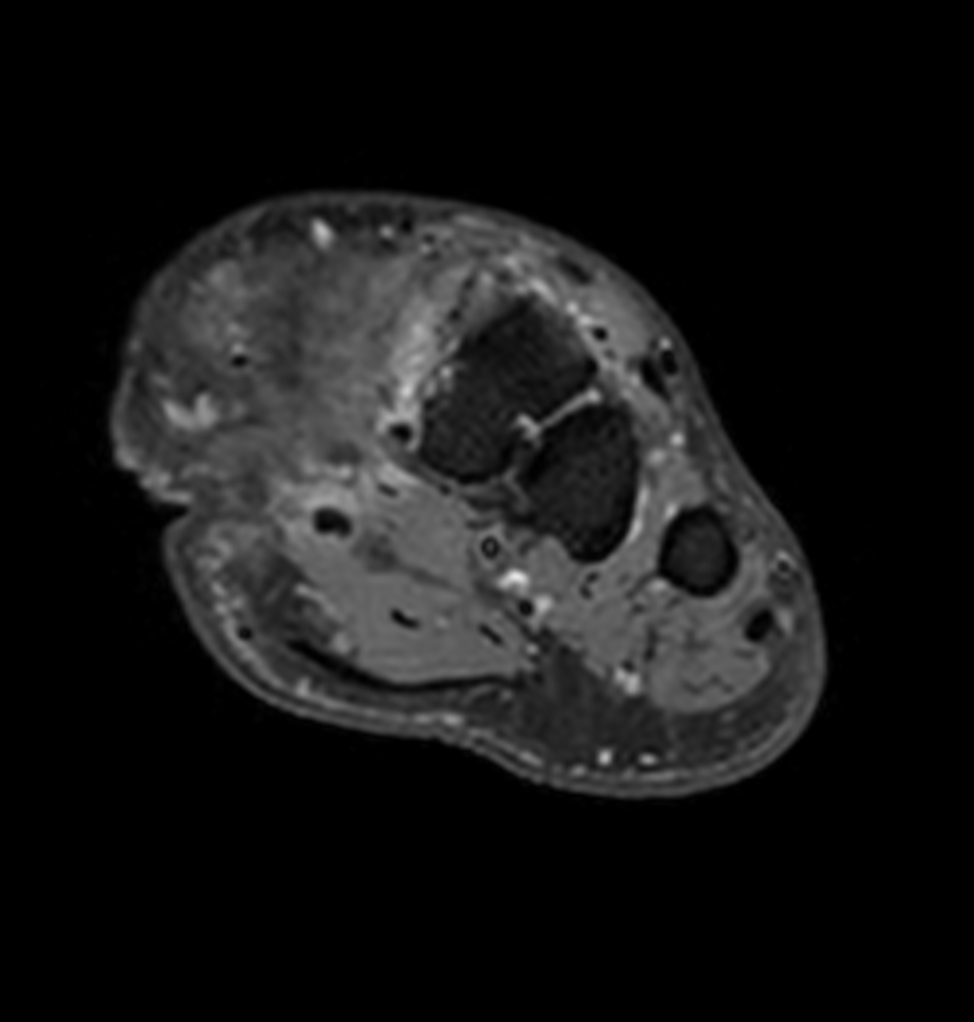 3D VIEW PDw SPAIR - Axial reformat