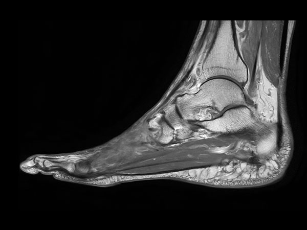 Sagittal T1w TSE with gado