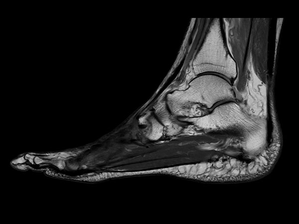 Sagittal PDw mDIXON XD TSE (In Phase)