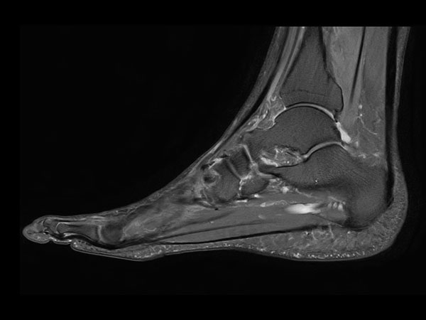 Sagittal PDw mDIXON XD TSE (Partial FatSat)