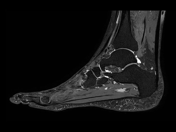 Sagittal 3D VIEW PDw SPAIR