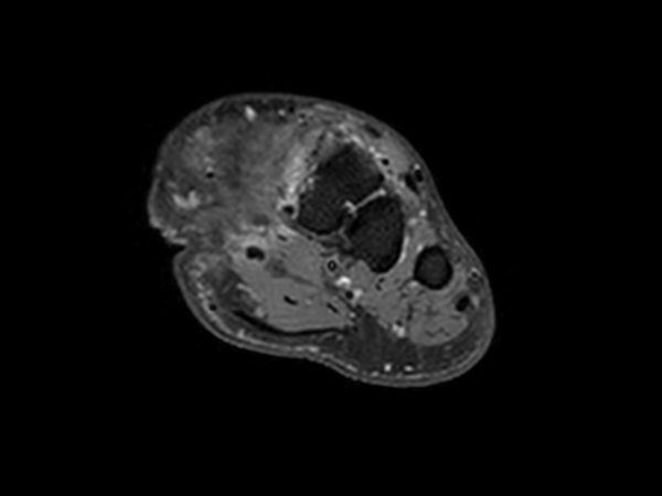 3D VIEW PDw SPAIR - Axial reformat