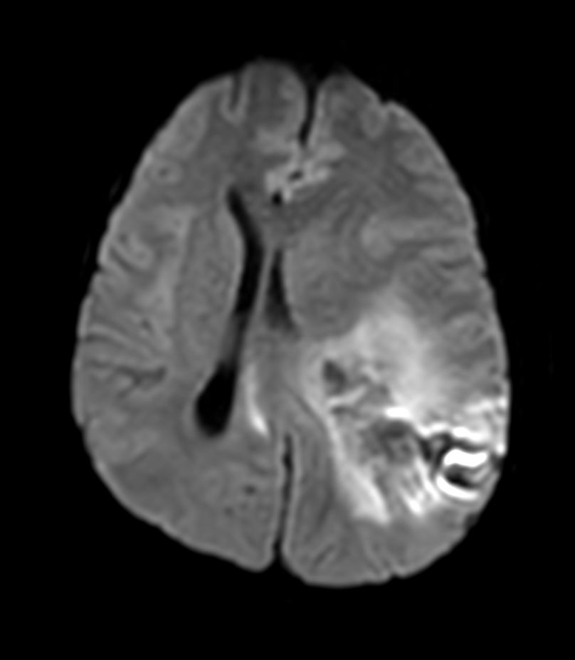 Axial Diffusion (b1000)