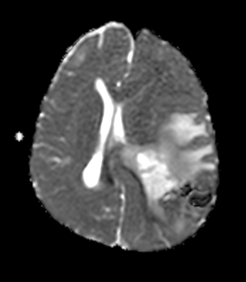 Axial Diffusion (ADC)