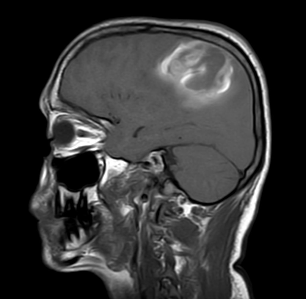 Pediatric Brain With Hemorrhagic Mass Philips MR Body Map ct-venogram-brain-rad-ct-guide