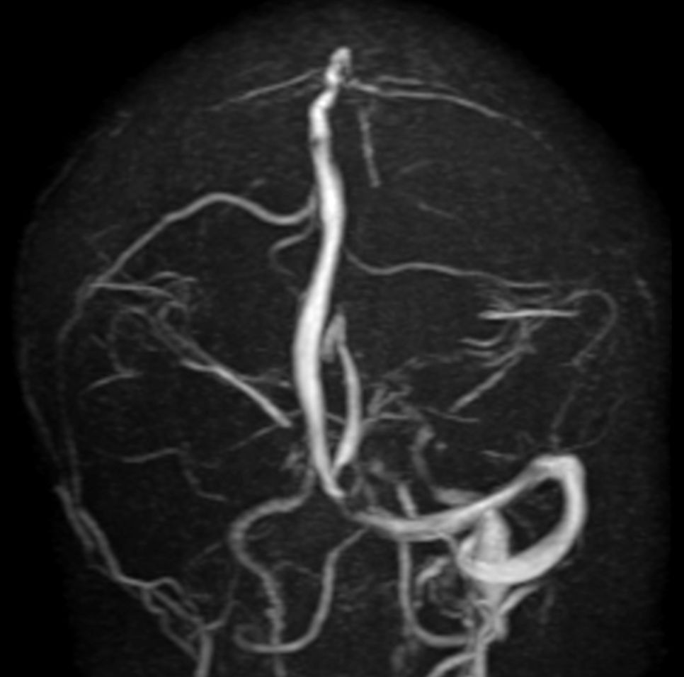 Coronal PCA Venogram (MIP)