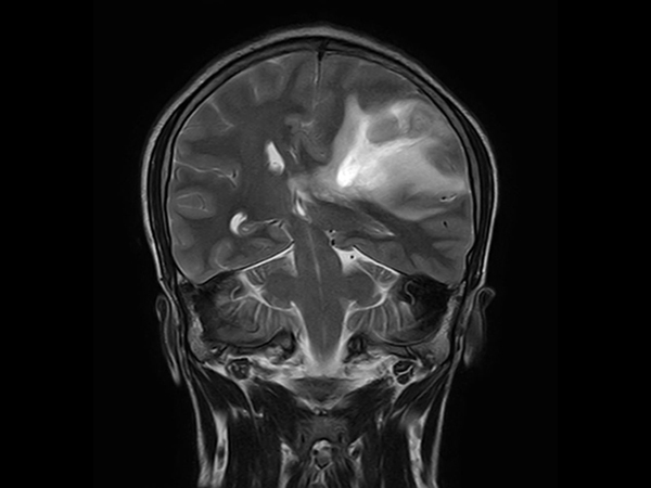 Coronal T2w TSE