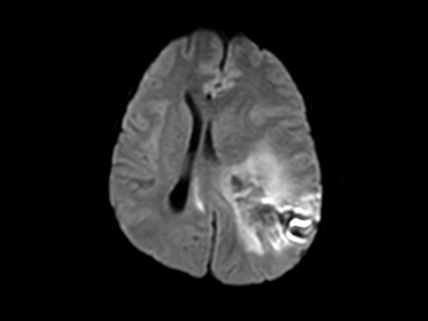 Axial Diffusion (b1000)