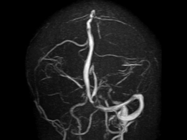 Coronal PCA Venogram (MIP)